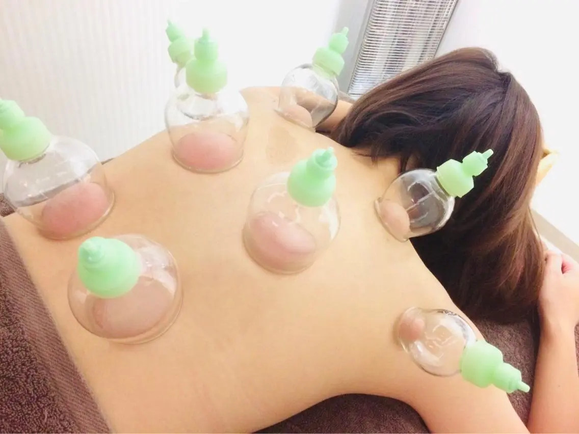 カッピング療法の写真