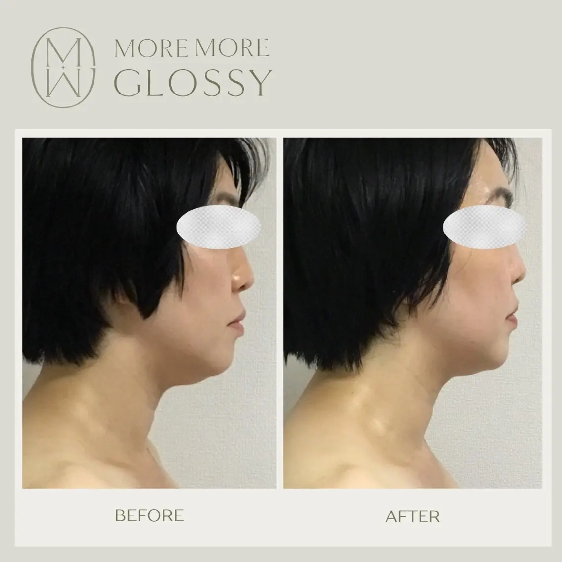 【エイジングサイン対策】たるみ、ほうれい線によるフェイスラインのもたつき悩みに特化📣💎眠れる美女コルギ70分💆の写真