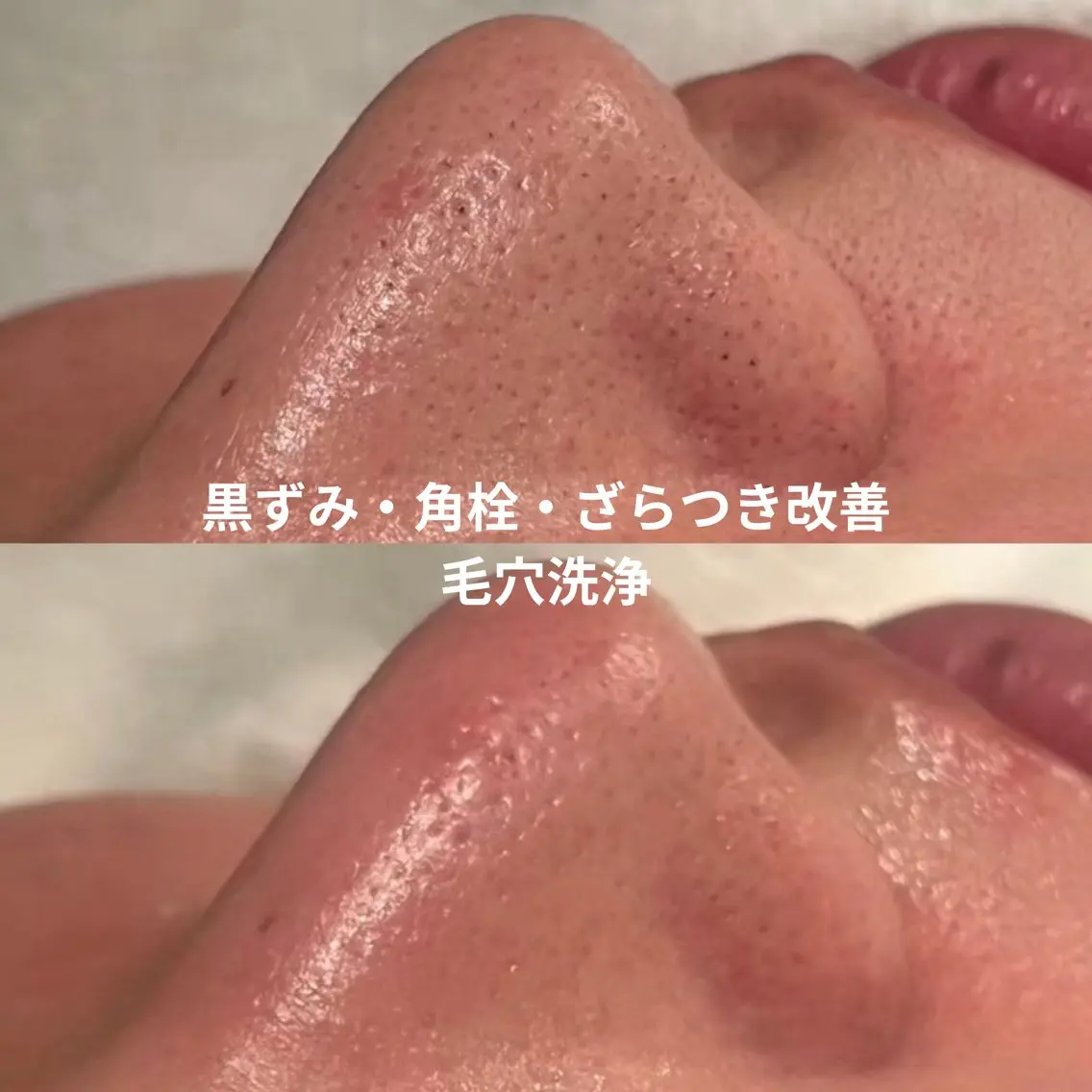 【初回】毛穴洗浄✨黒ずみ・角栓・毛穴のざらつきが気になる方にの写真
