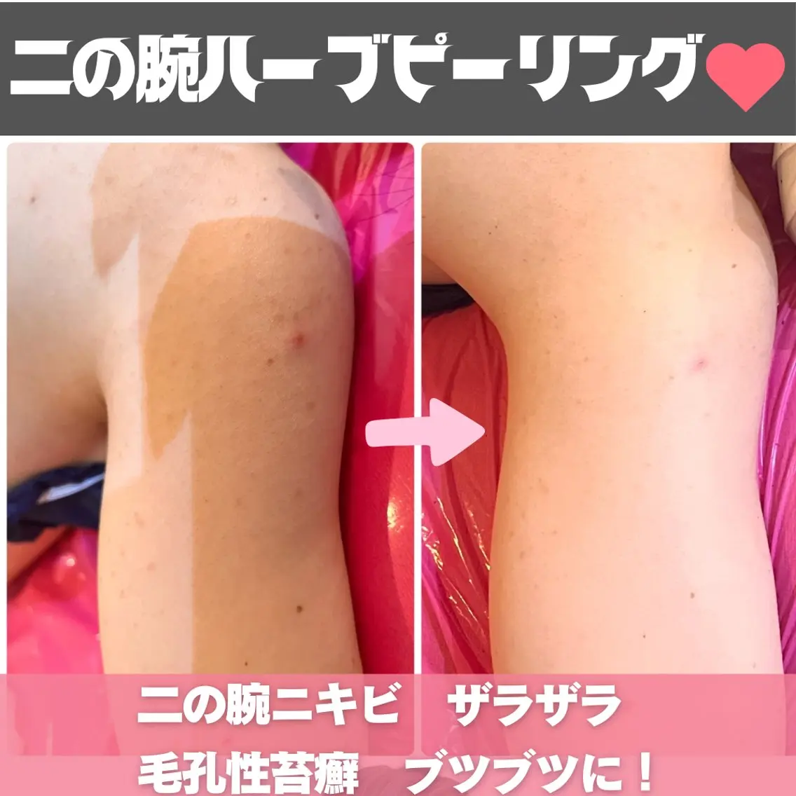 エステ 切らない脂肪吸引🔥 Neroliまりこのエステ・リラクイメージ