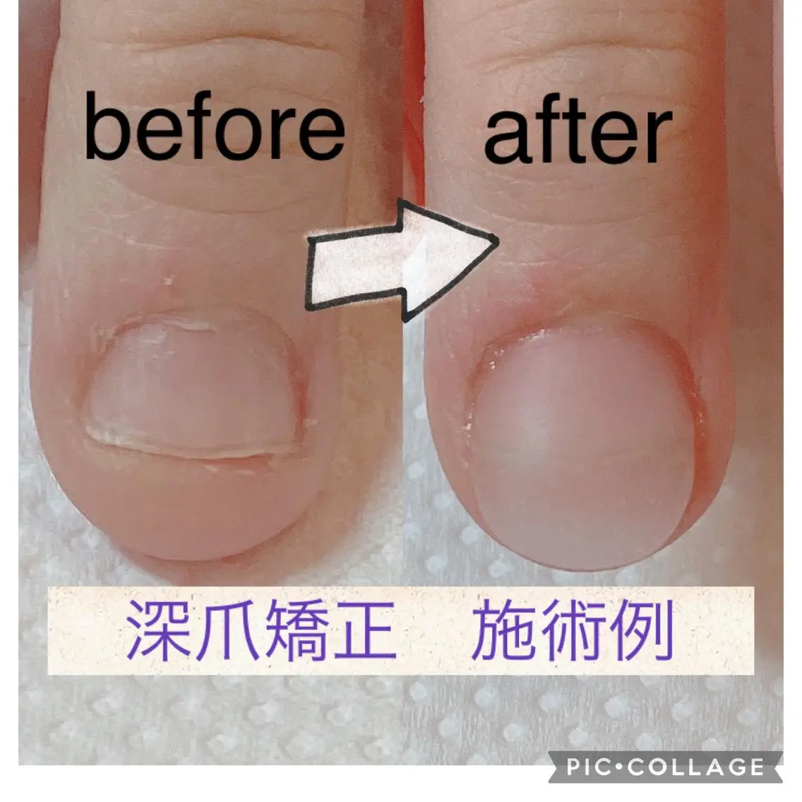 ウォーターケア＋深爪矯正にも⭐︎アクリルスカルプチュアの写真