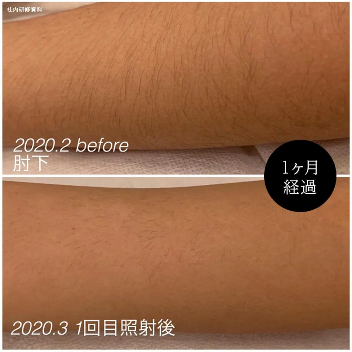 【初回】抜ける！最強光脱毛　全身(VIO+顔　込み)の写真