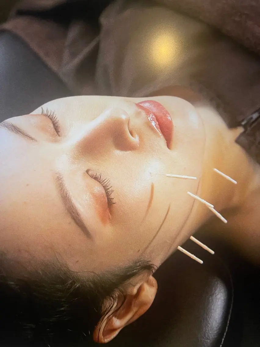 【睡眠時の食いしばりや睡眠状況が悪い方】美容鍼+お顔のEMSの写真
