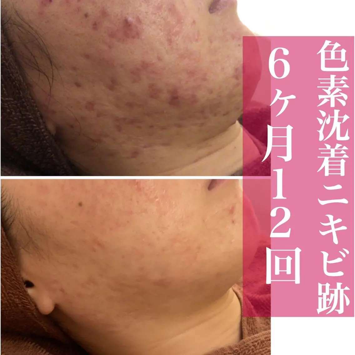ミディアム カラー パーマ ヘアアレンジ メンズ キッズ ネイル マツエク・マツパ アイブロウ エステ リラク ニキビ・肌質改善専門 ♡人生が変わるサロンのエステ・リラクイメージ