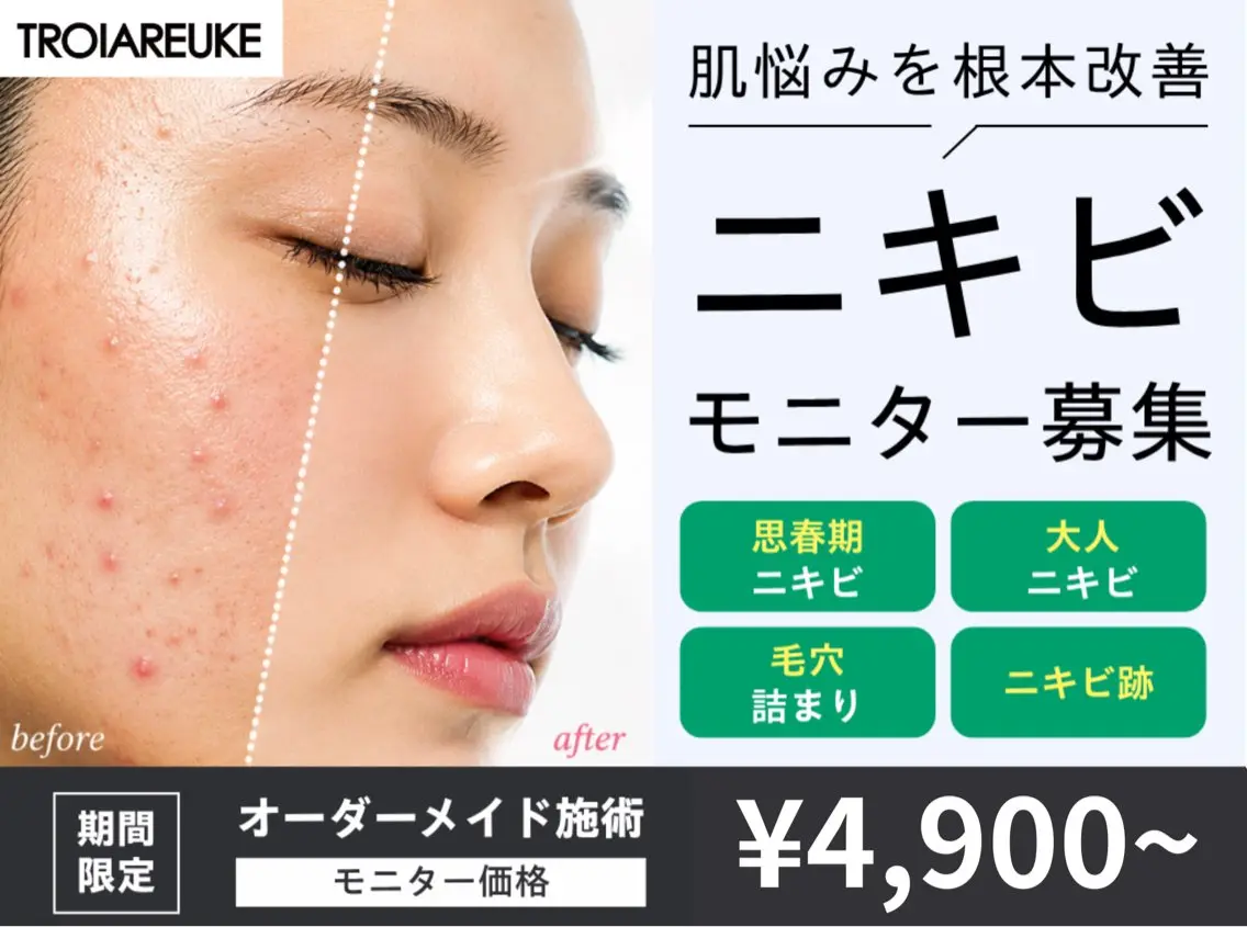 【期間限定モニター募集】ニキビでお悩みの方の写真