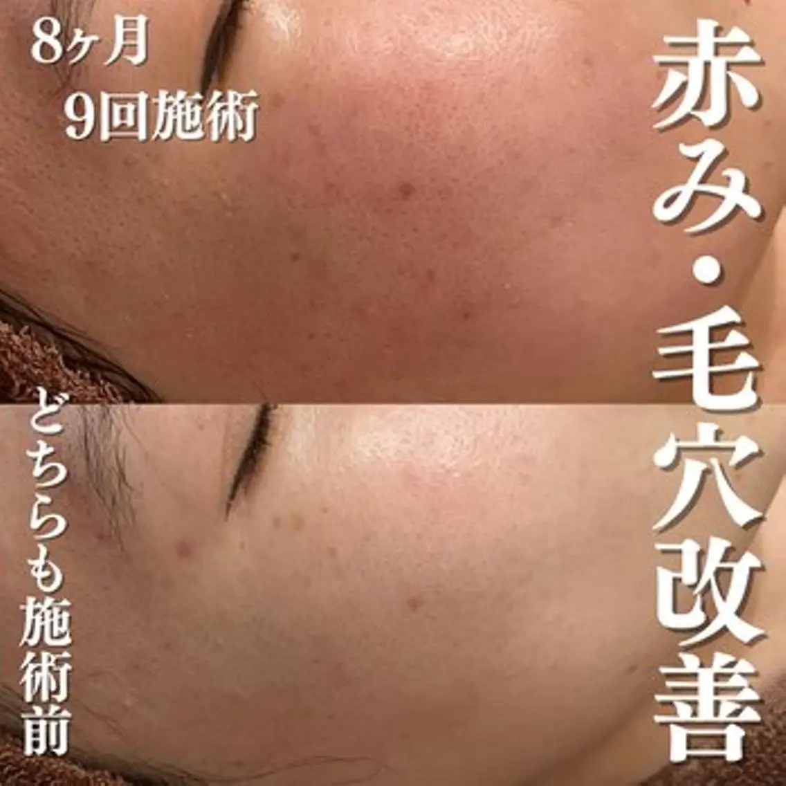 エステ リラク 3か月で肌革命👼 ニキビ専門店💫のエステ・リラクイメージ