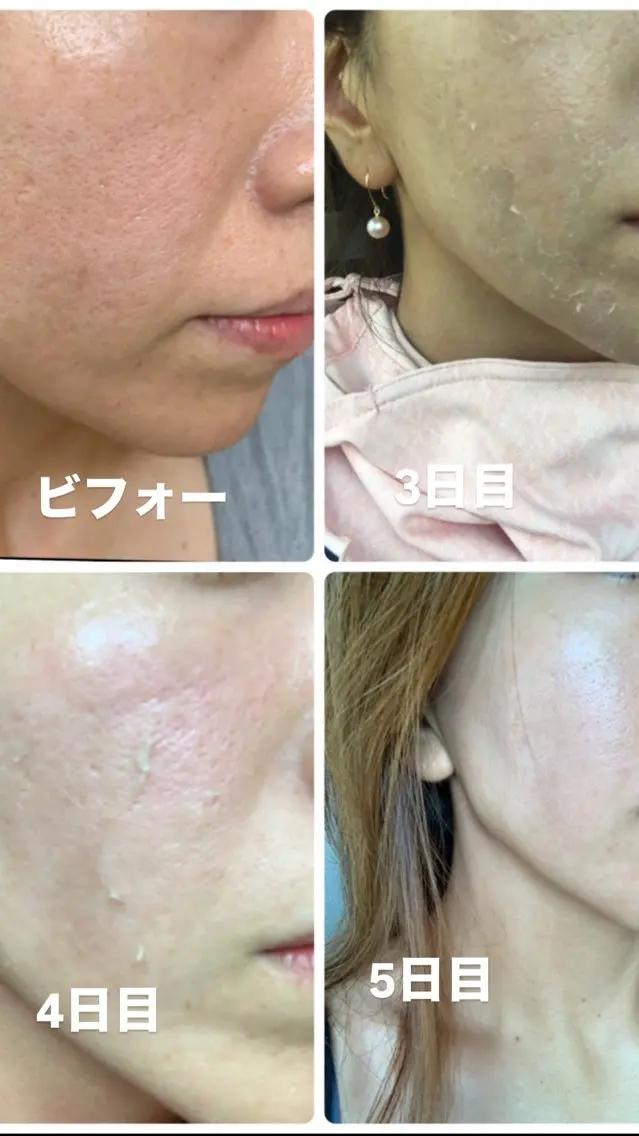 エステ つるんとむき卵肌に 🌟ハーブピーリングのエステ・リラクイメージ