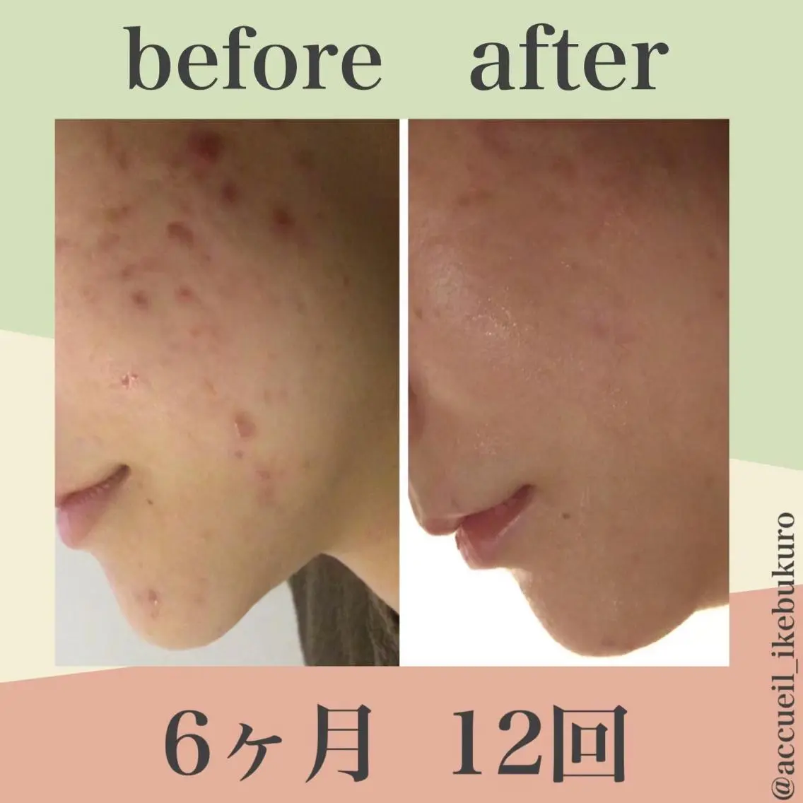 ミディアム カラー パーマ ヘアアレンジ メンズ キッズ ネイル マツエク・マツパ エステ リラク ニキビ・肌質改善専門 ♡人生が変わるサロンのエステ・リラクイメージ