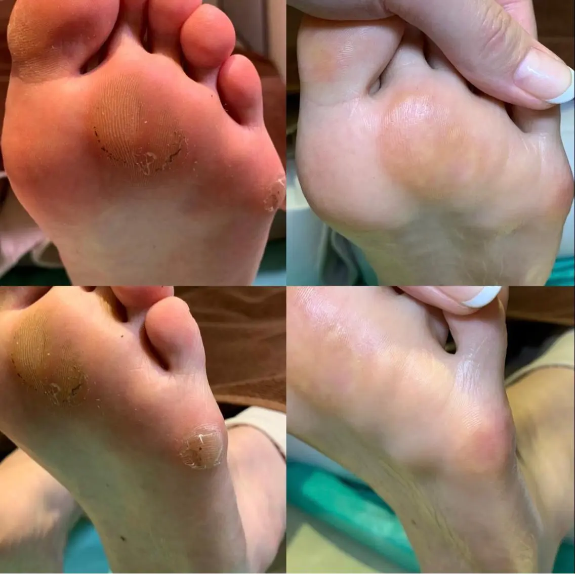 【足裏タコケア】足裏にできたゴワゴワ🌀角質もスベスベの足裏に✨是非お試しください💁‍♀️の写真