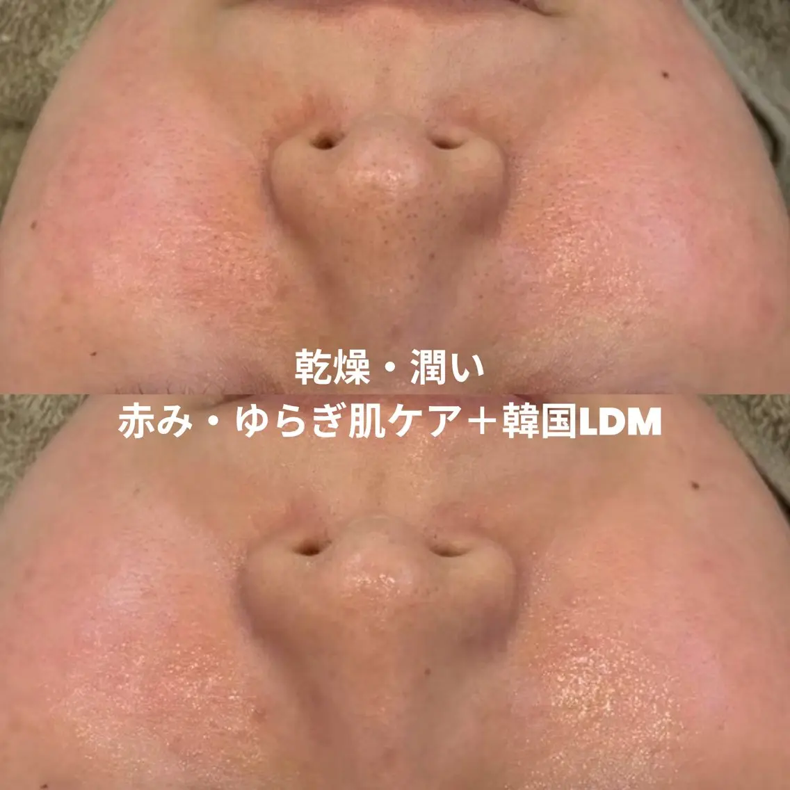 【初回】赤み・ゆらぎ肌ケア+韓国LDM🌿乾燥・うるおい集中ケアの写真