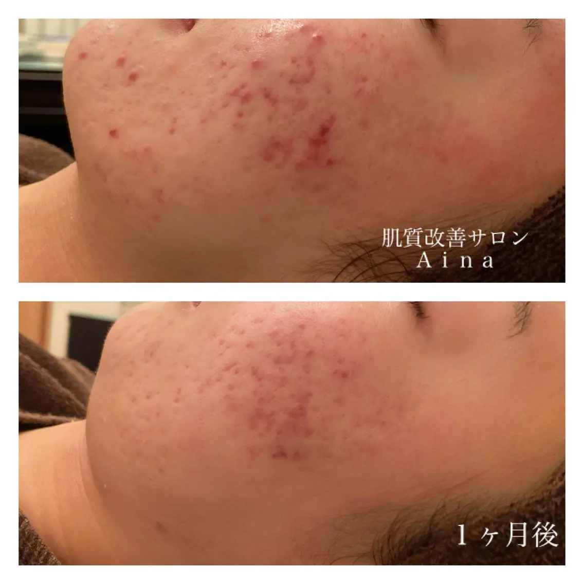 ミディアム カラー パーマ ヘアアレンジ メンズ キッズ ネイル マツエク・マツパ 卒業式のヘアスタイル 卒業式 赤色 エステ リラク ニキビ跡専門サロン Ainaのエステ・リラクイメージ