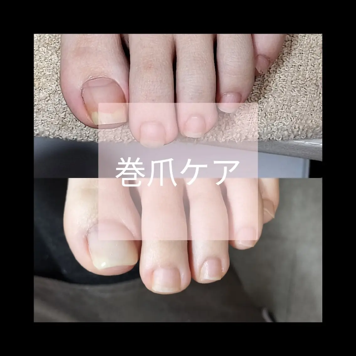 巻爪ケア親指2本＋フットケア(フットバス＋甘皮ケア＋爪切形成＋保湿)の写真