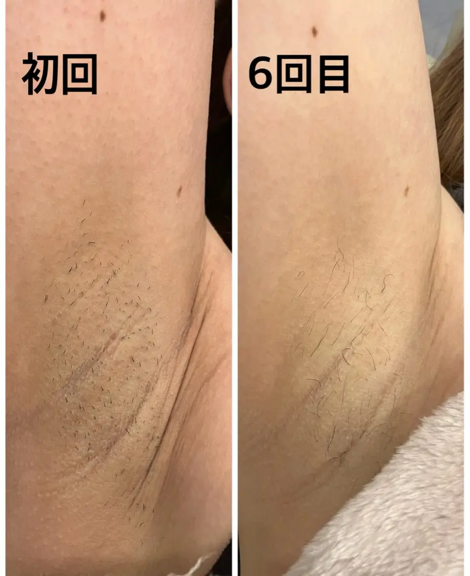 脇脱毛の写真