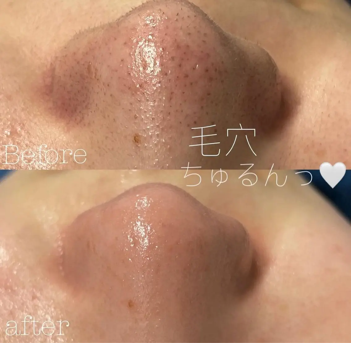 毛穴洗浄の写真