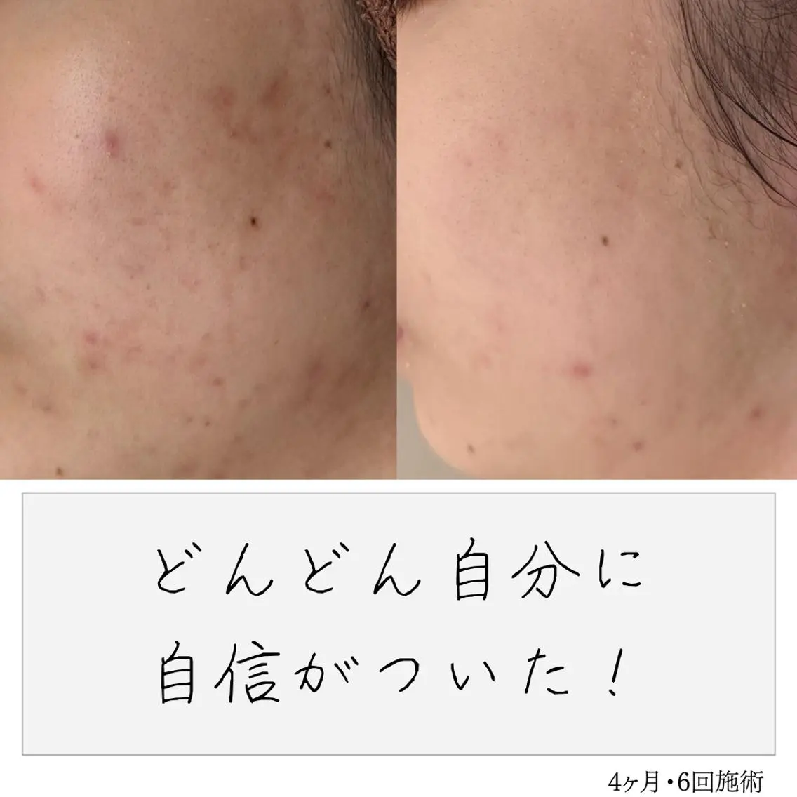 ニキビ経験者が施術 する専門サロン🌻のエステ・リラクイメージ