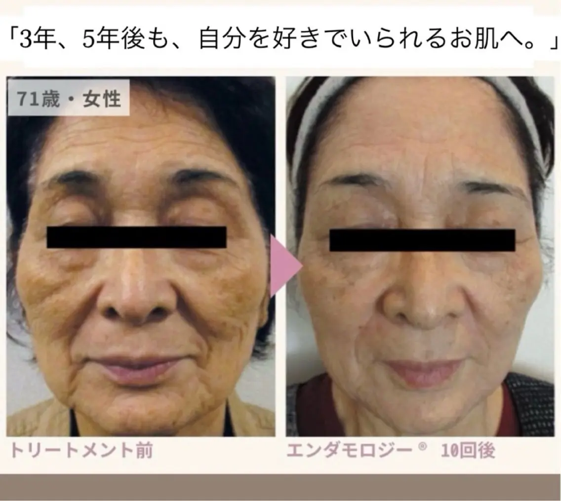 潤い&引き上げ《毛穴/リフトアップ/小顔/キメ/美肌/艶肌》エンダモロジーフェイシャル+エレクトロポレーションの写真