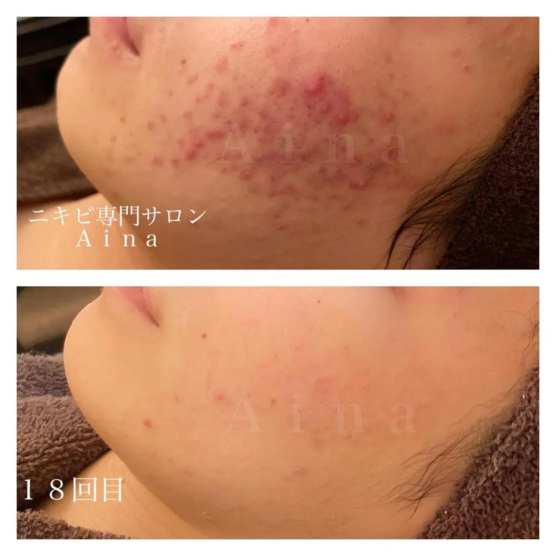 ミディアム ヘアアレンジ メンズ キッズ ネイル マツエク・マツパ 赤色 ニキビ跡専門サロン Ainaのエステ・リラクイメージ
