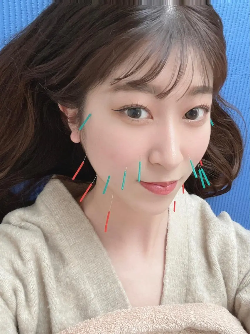 美容鍼（しわの引き伸ばし）の写真