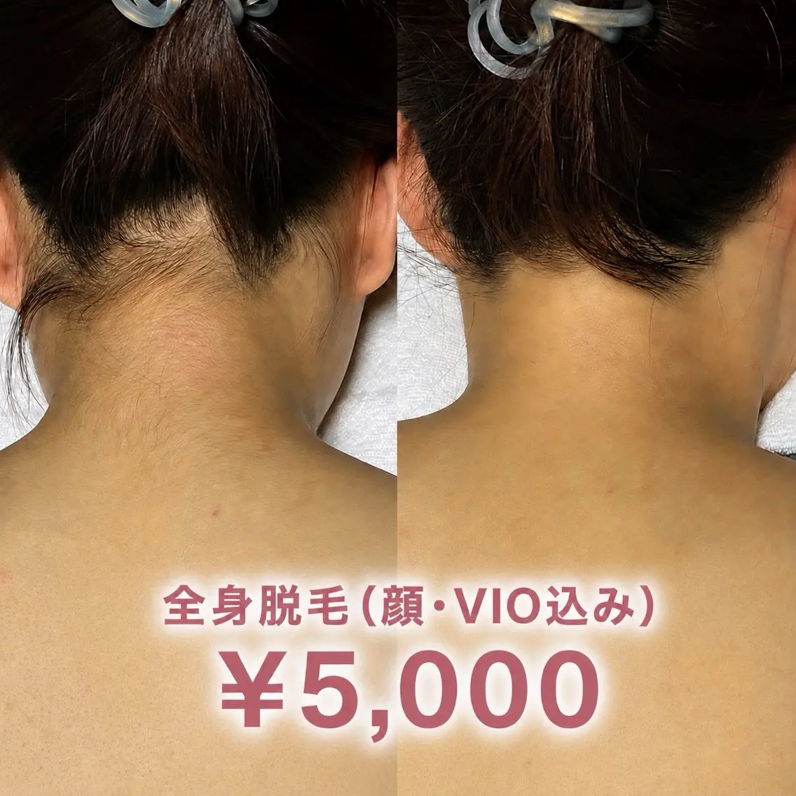 【限定クーポン⭐︎】全身脱毛(顔・VIO込み) ¥5,000の写真