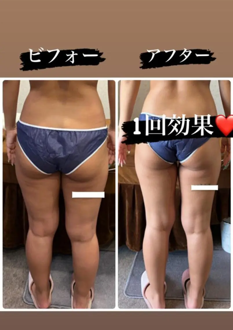 💎究極の部分的痩せ💎10000ショットボディ💎美容整体のサービス付き🥰の写真