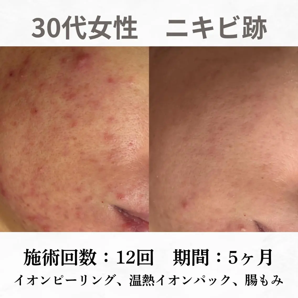 重度ニキビ専門🌷 ダウンタイムなしのエステ・リラクイメージ