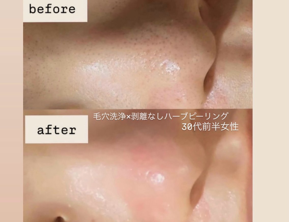 【人気NO1👑】毛穴洗浄×ハーブピーリング40分｜鼻などの黒ずみ・角栓徹底除去◎悩んだらコレ／男性+￥1,000の写真
