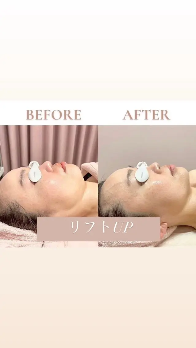 【フェイスラインのもたつき•たるみに】🌷リフトUP小顔フェイシャルの写真