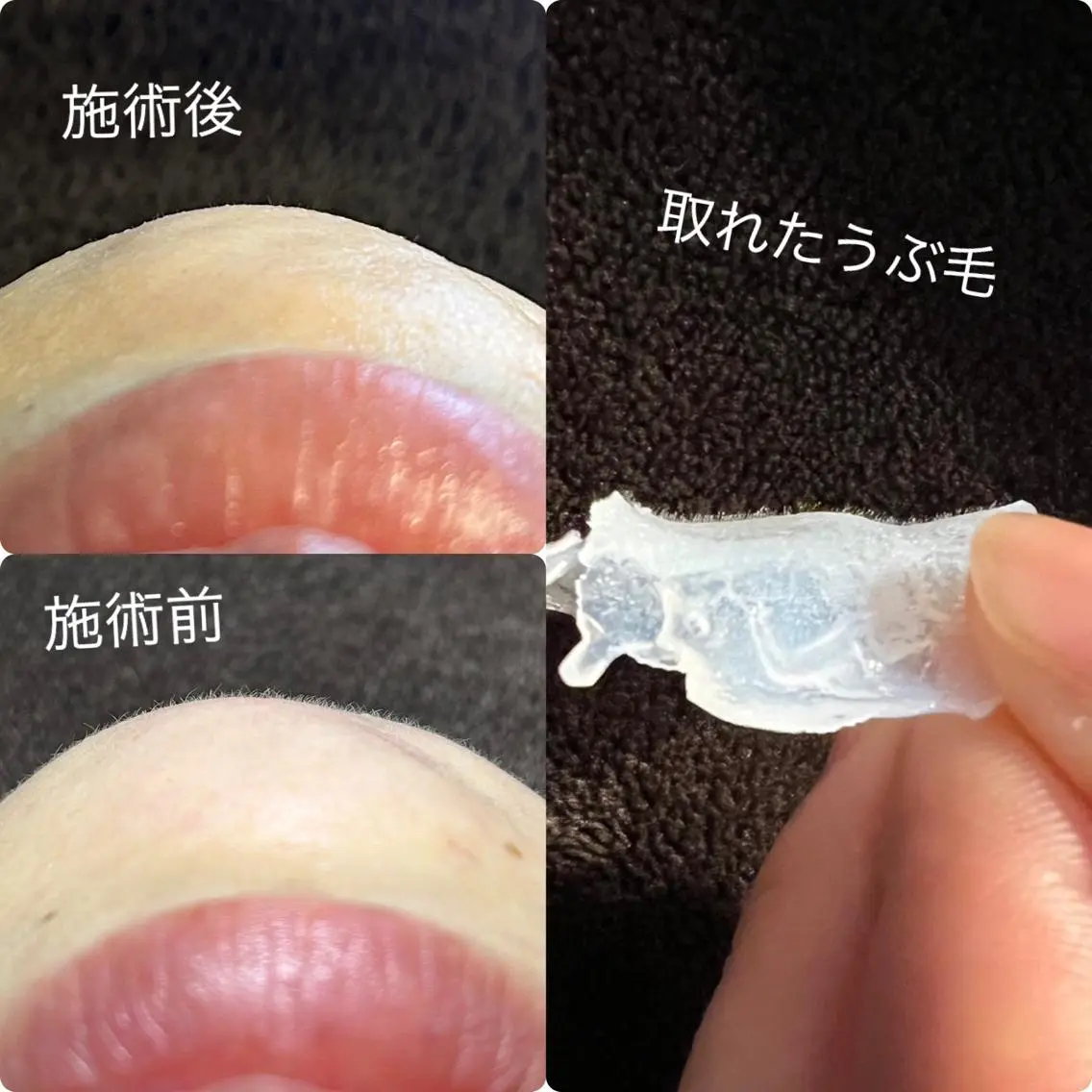 【フェイシャルワックス】施術内容-ディープクレンジングプレケア(下処理）鎮静＆艶肌導入パックお仕上げワックス脱毛の写真