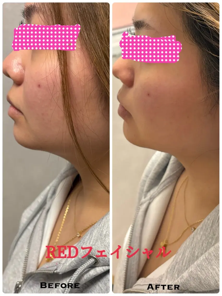 💎【フェイスライン引き締め】小顔リフトケア お肌を錆びさせない効果のある美容液使用の写真