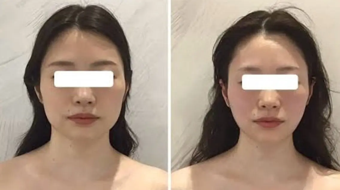 【美顔フェイスラインスッキリ】レモンぼとるフェイシャルの写真