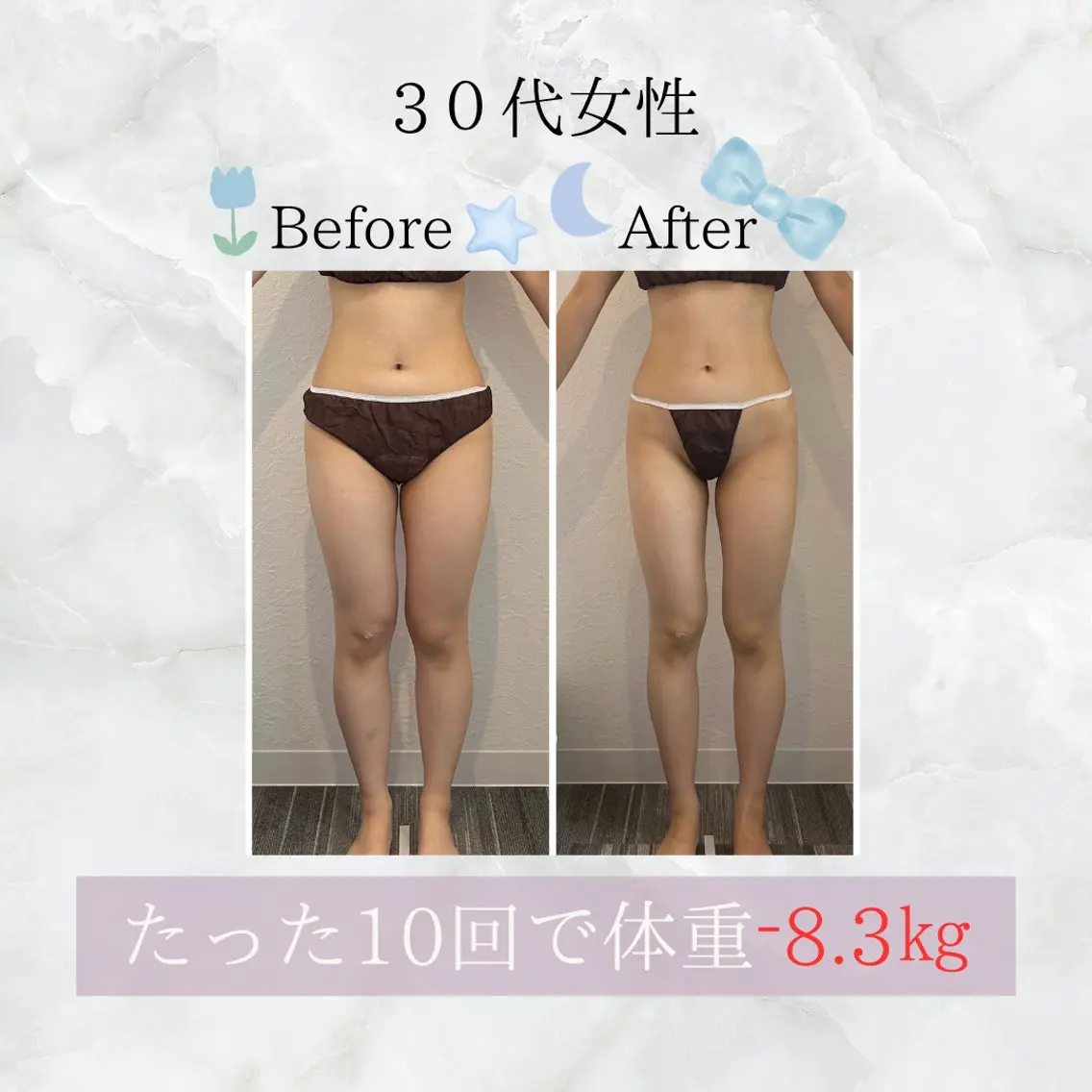 【痩身/全身】ハイパーナイフ90分の写真