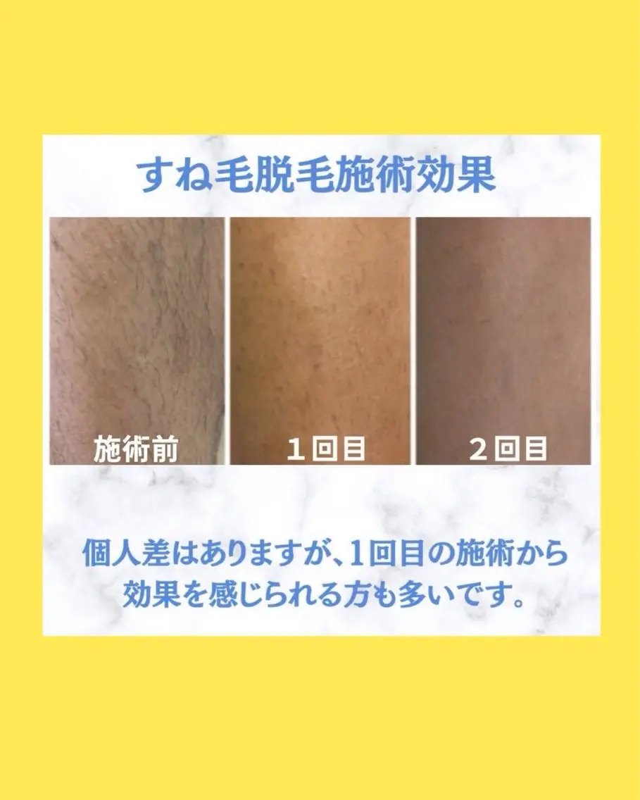 💎都度払いOK🌿25分セルフ脱毛＆光エステ✨メンズ・中学生以上歓迎！勧誘なしで気軽に通える♪【使い放題】の写真
