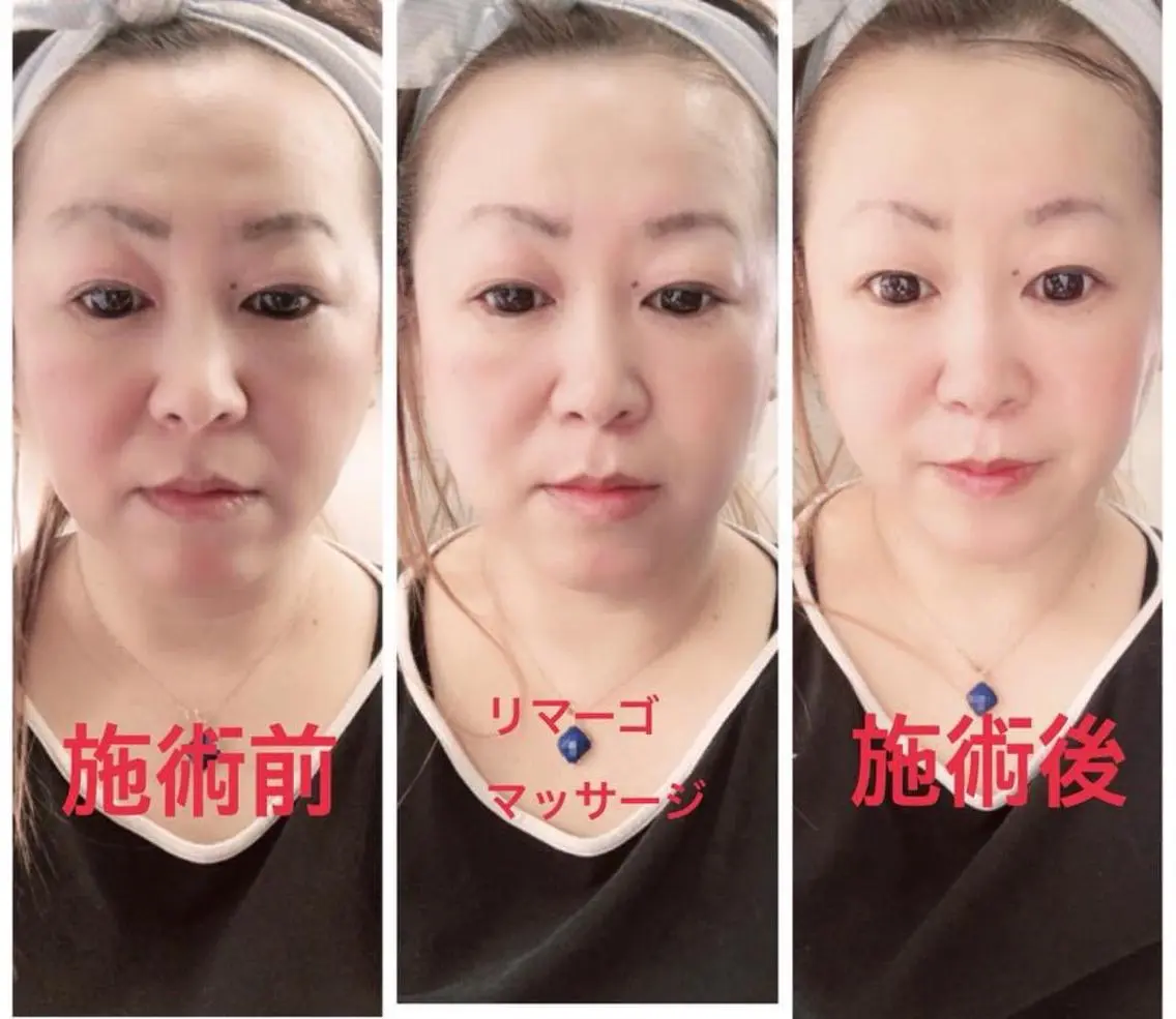 【しわ、たるみ、老化が気になるあなたに必見】ミラクルウェーブ （しわ、たるみケア）フェイシャル＋コラーゲンマシン４０分の写真