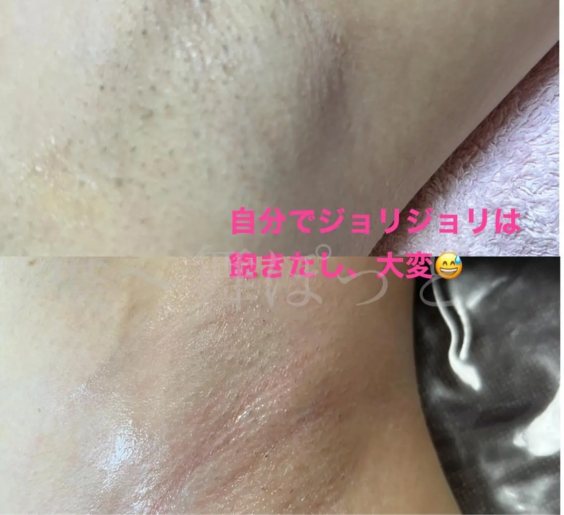 シュガーリング脱毛　脇の写真