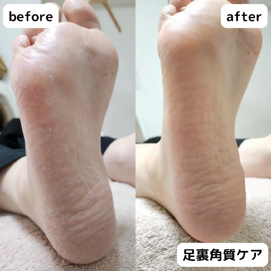 足裏角質ケア👣ガサガサかかと、気になるところバイバイ🙋ふわふわなお足元に🦶✨の写真