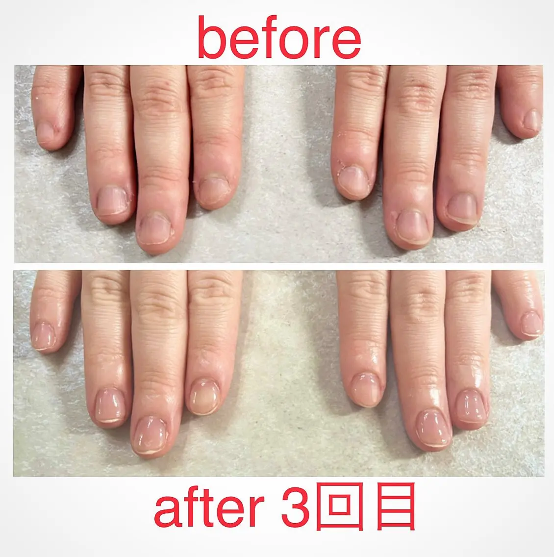 美爪ケア⭐︎育爪⭐︎クリアジェルモデル様募集　自爪が短い方、深爪の方、噛み癖のある方など⭐︎３回施術してくださる方募集の写真