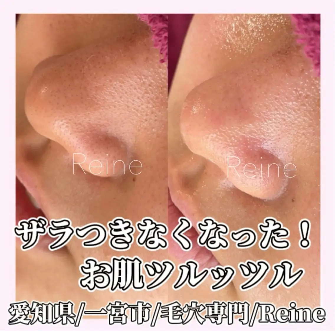 毛穴/シミ肝斑/脱毛 横山梨里のエステ・リラクイメージ