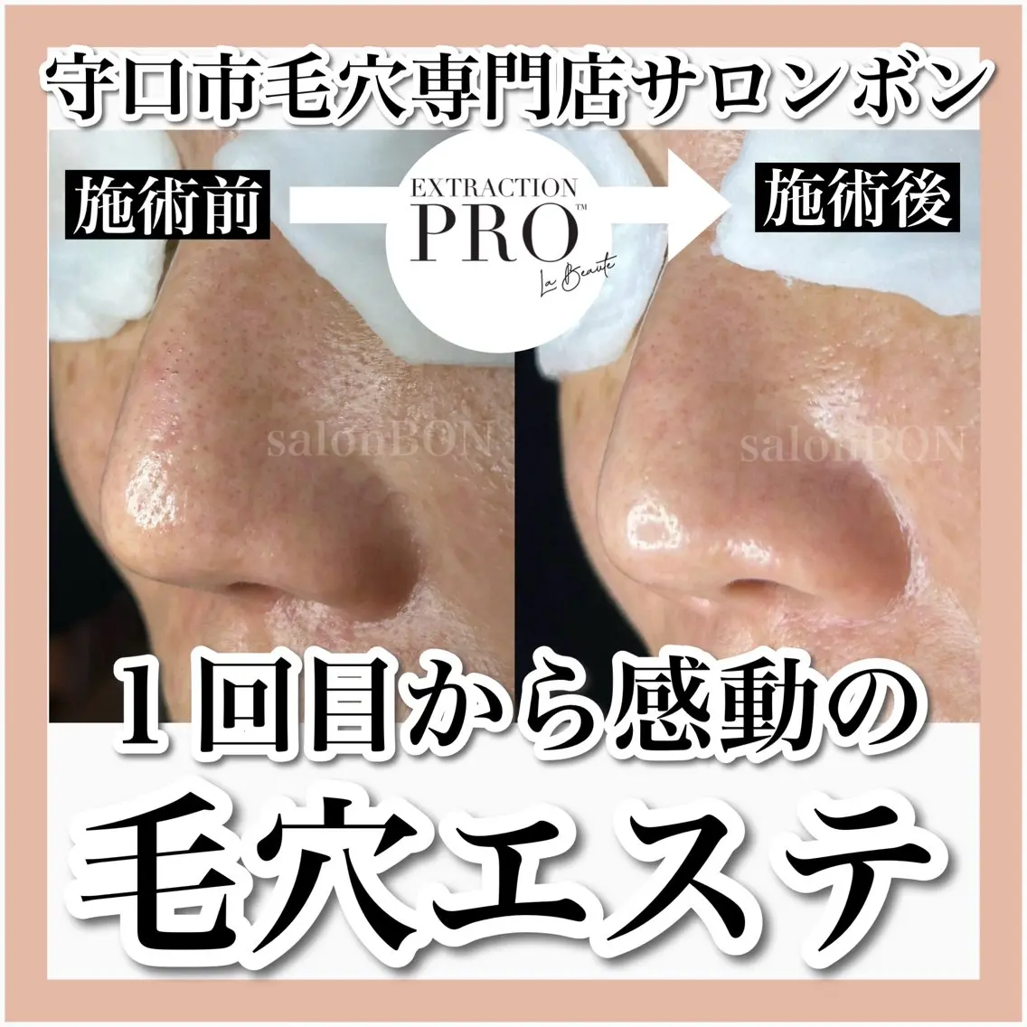 艶肌✨毛穴改善コースの写真