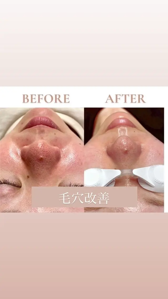 【黒ずみ•開き毛穴に】🌷毛穴改善フェイシャル🌷の写真