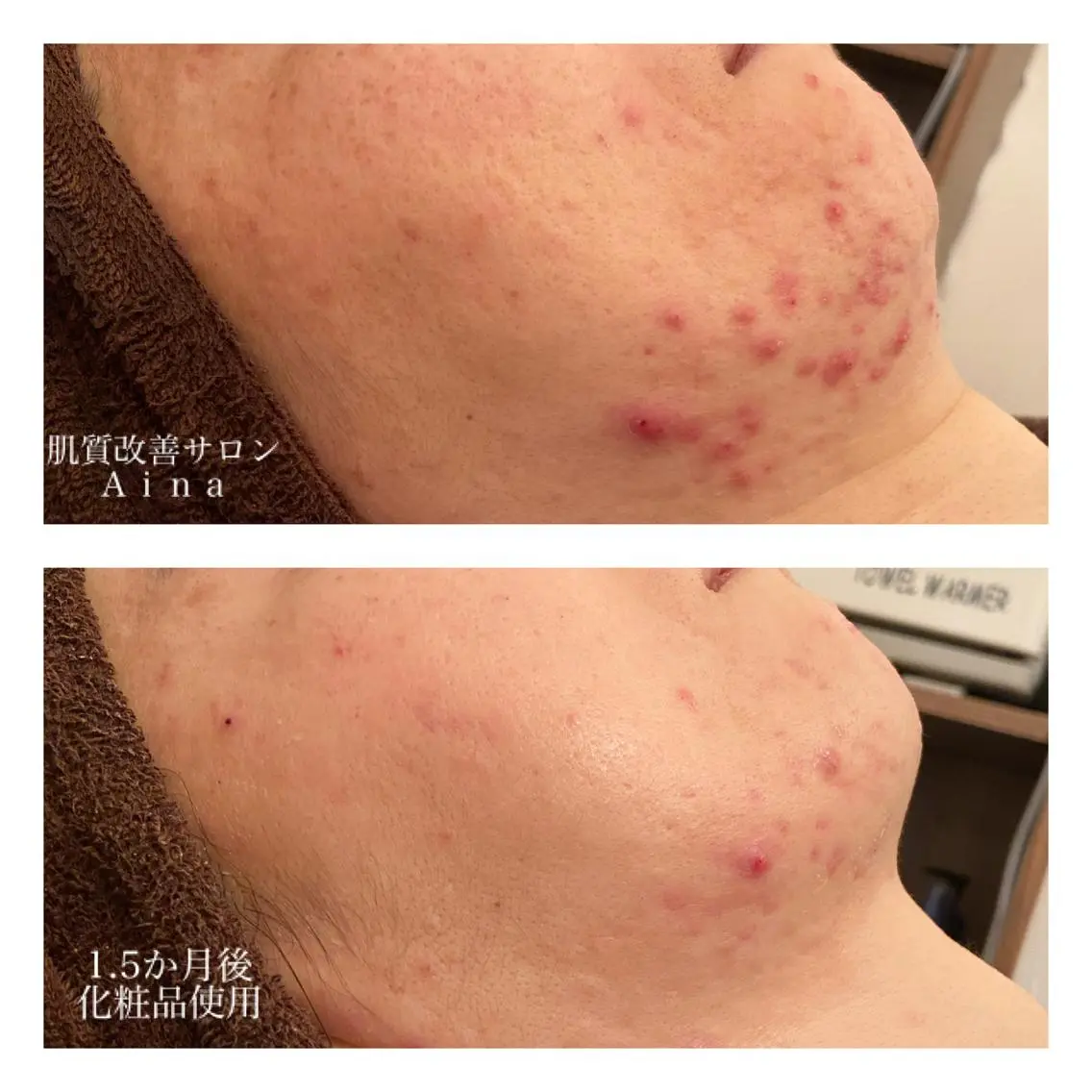 ミディアム カラー パーマ ヘアアレンジ メンズ キッズ ネイル マツエク・マツパ エステ リラク ニキビ跡専門サロン Ainaのエステ・リラクイメージ