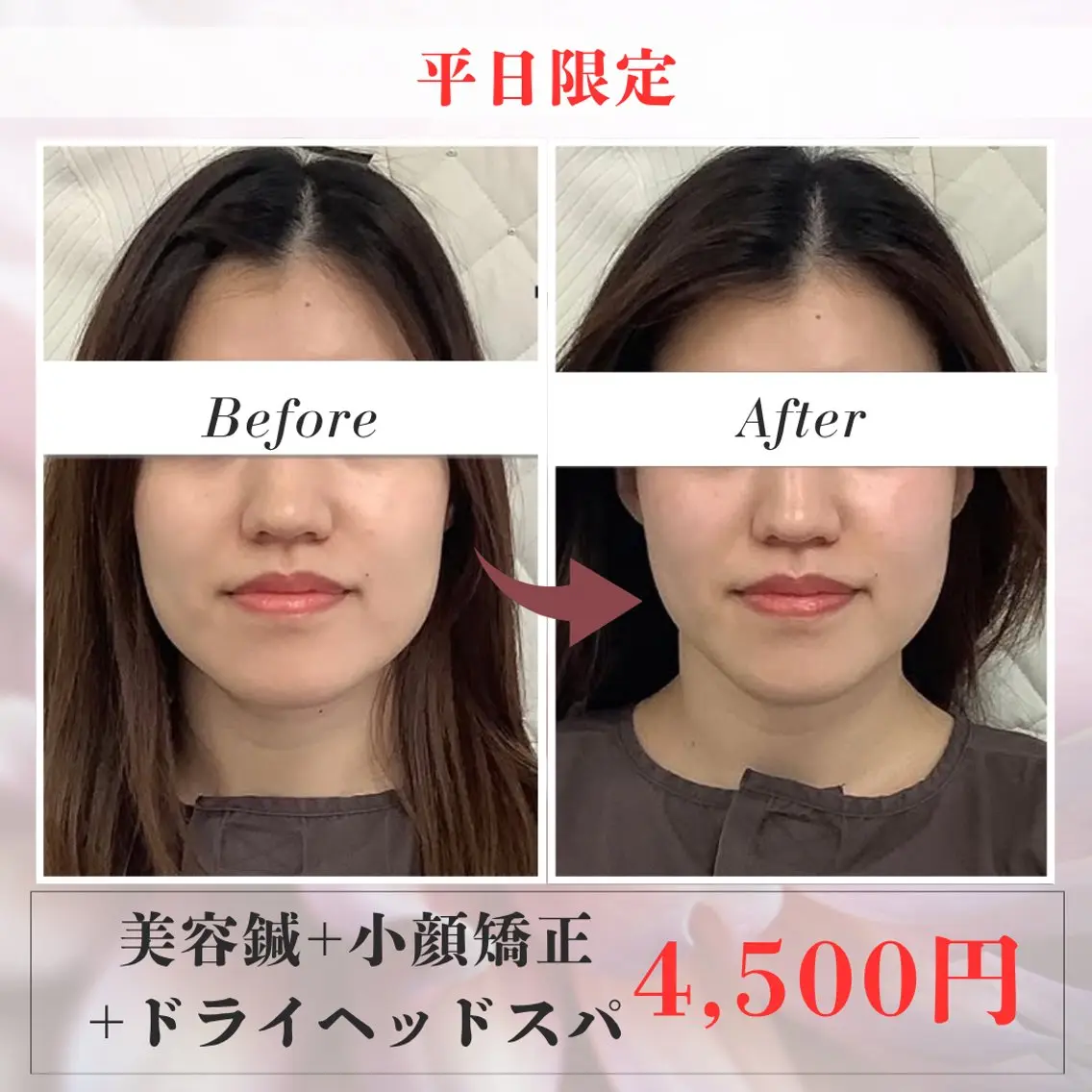 【👑人気No.1👑】美容鍼+小顔矯正+ドライヘッドスパ(60分)の写真
