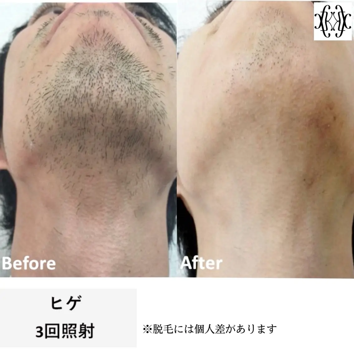 メンズ脱毛【ヒゲ】の写真