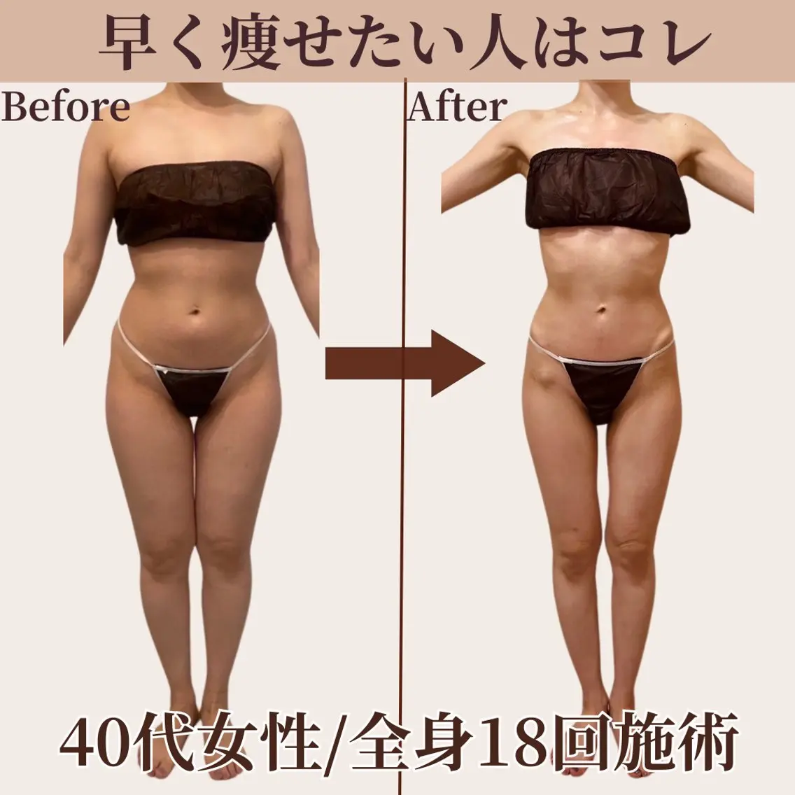 【全身☆痩身】360°大変身！早く痩せたいならこちら♪憧れのLL→Mにサイズダウン★《初回限定💫特別価格》の写真