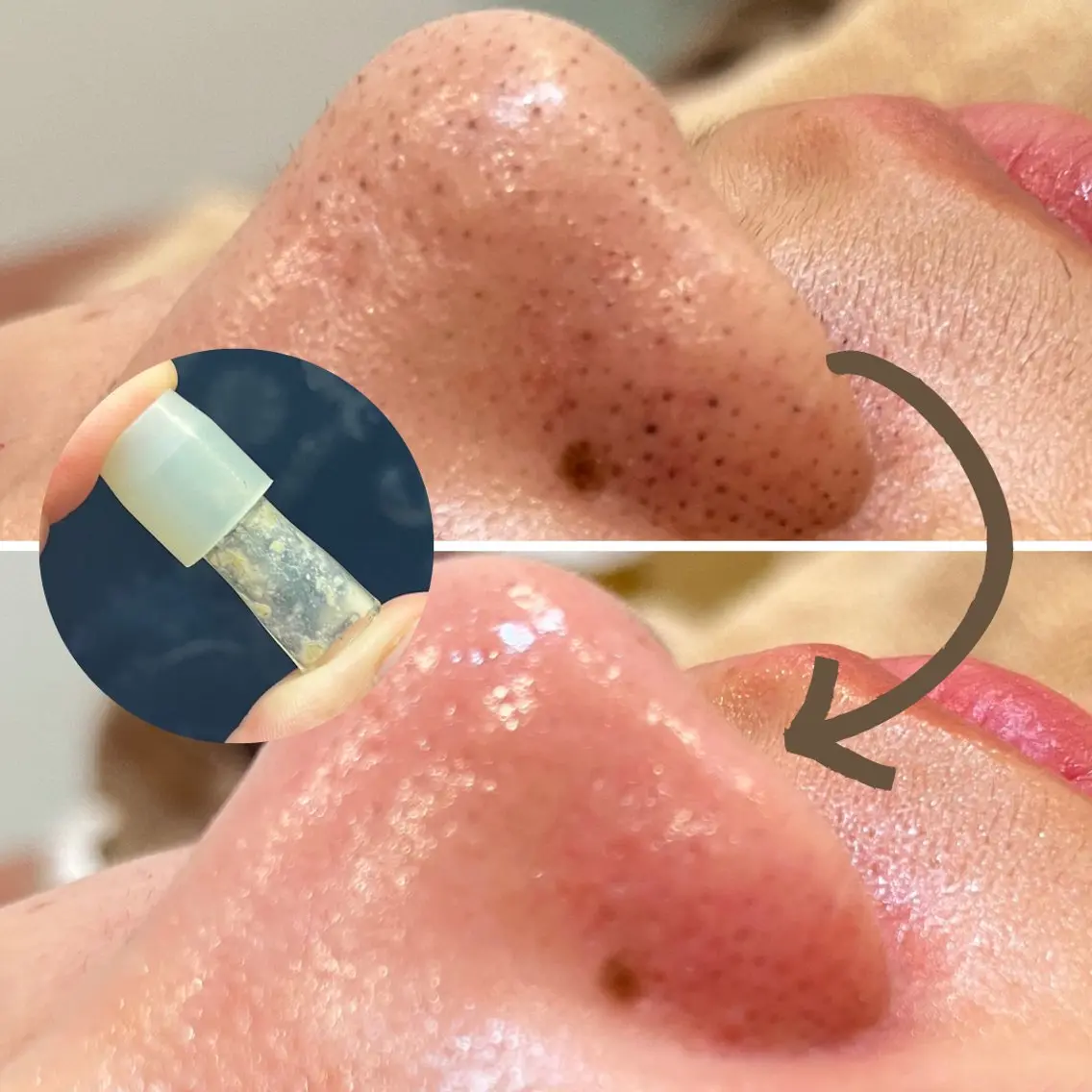 毛穴レス美肌体験|👃吸引洗浄フェイシャルの写真
