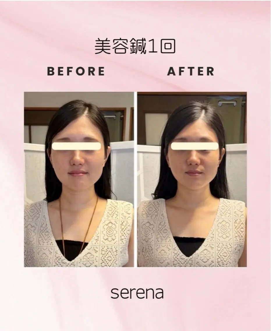 エステ 美容鍼×小顔エステ serenaのエステ・リラクイメージ