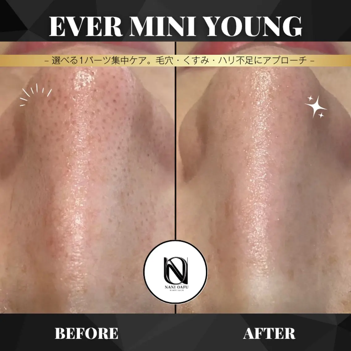 【✨選べる1パーツ集中ケア】EVER MINI YOUNG｜毛穴・くすみ・ハリ感サポート〈メンズOK〉の写真