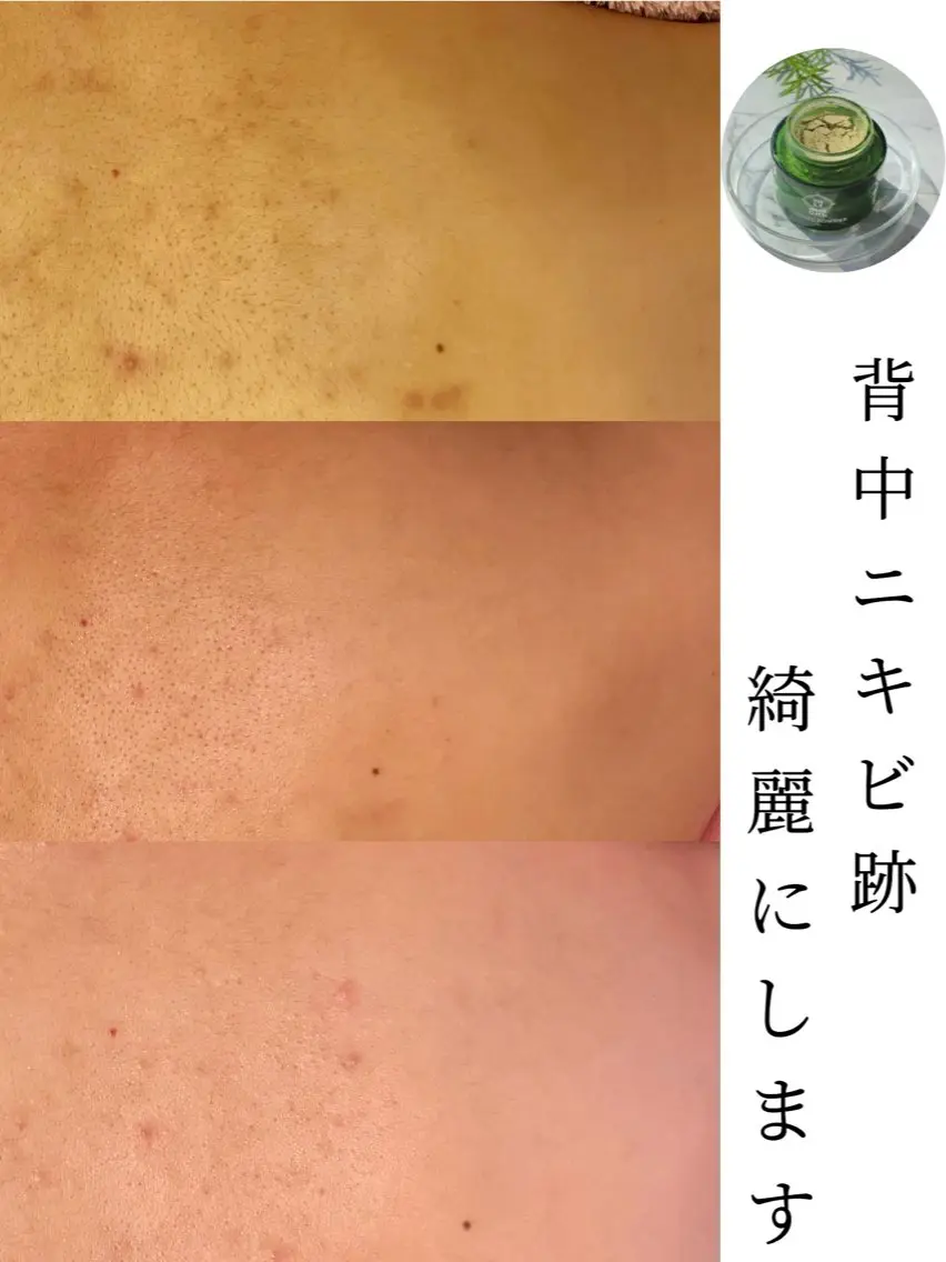 エステ 小顔&毛穴・肌質改善 LINDA西宮 AIのエステ・リラクイメージ
