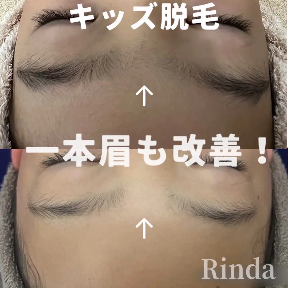 体毛でお悩みのお子様に【キッズ全身脱毛10歳~12歳年齢別限定】痛みが少ない全身美肌脱毛の写真