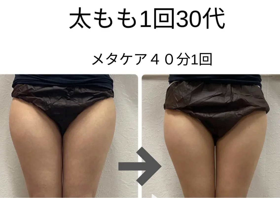 【脂肪に直接アプローチ!効果絶大】メタケア+ハンドケア(1パーツ) 40分¥15,600→¥6,000の写真