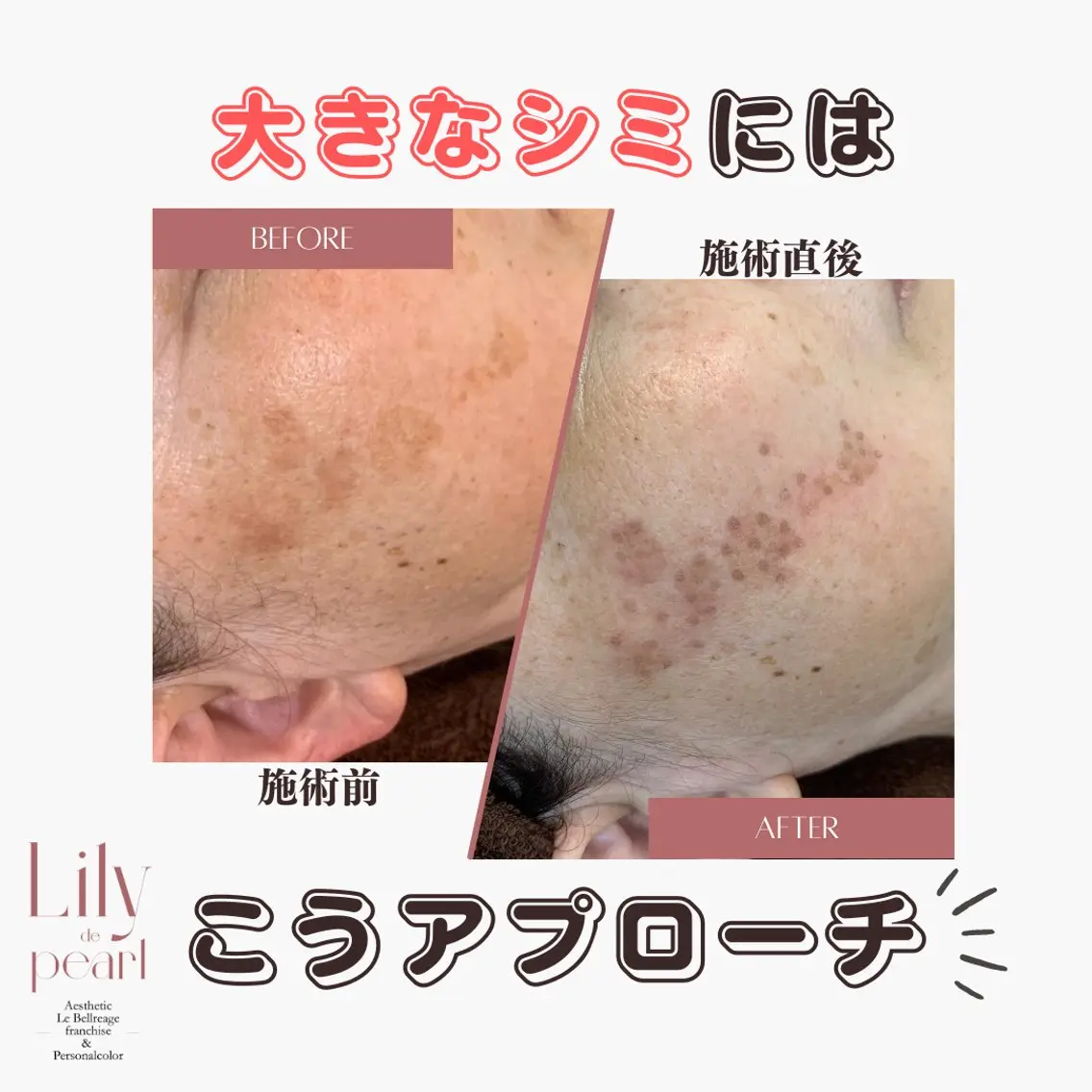 エステ 最新シミケアLily de pearlのエステ・リラクイメージ